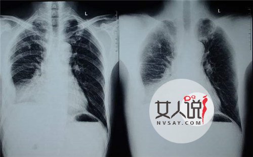 结核性胸膜炎能根治吗 积极配合医生进行治疗