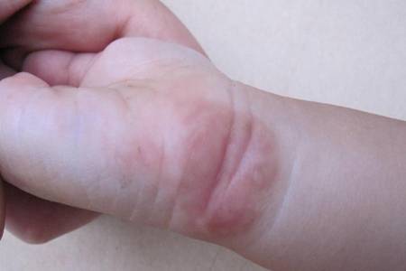 水肿是什么原因引起的?4种方法让你马上消除水肿