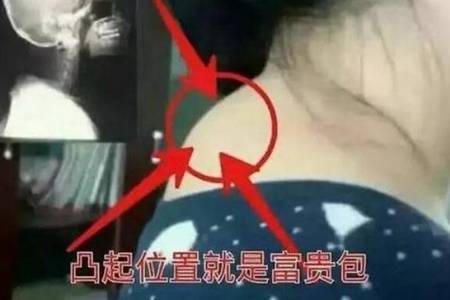 什么是富贵包怎么消除最有效 富贵包怎么形成的有什么危害