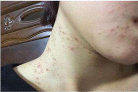 脖子上长痘痘是什么原因引起的？这四个原因不可轻视早点改善