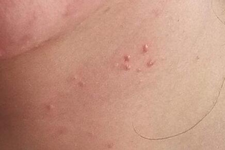 脖子上长痘痘是什么原因引起的？这四个原因不可轻视早点改善