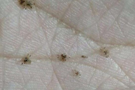 阴虱怎么彻底去除最简单的方法？这4招快速杀虫避免传染给伴侣