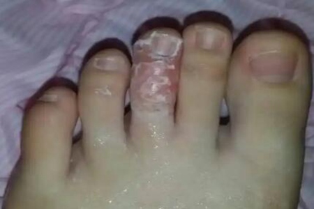脚气烂脚趾缝痒溃烂怎么治？这三个方法能脚气反复折磨痒