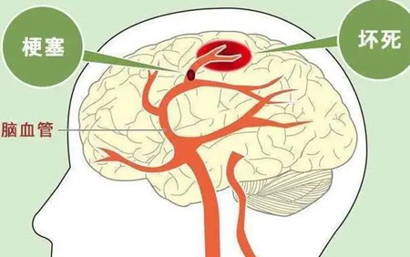 脑梗的症状都有哪些 如何自测及预防脑梗7大点